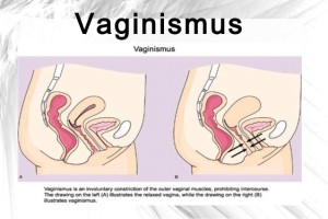 vaginismus and homeopathy - iranhomeopathymedicine