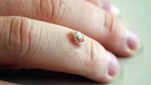 درمان زگیل انگشت و ناخن توسط طب هومیوپاتیHomeopathy -دکتر جلال میرعبداله-iranhomeopathymedicine.com 