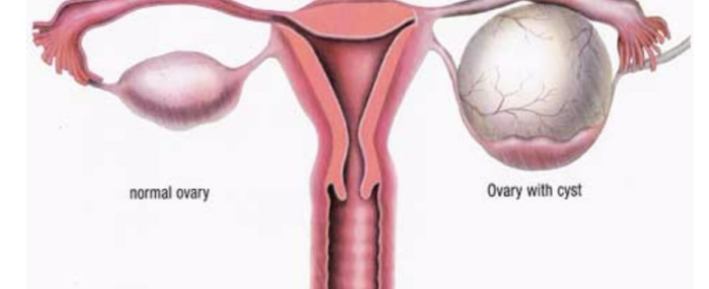 کیست تخمدان درمان هومیوپاتی homeopathy ovarian cyst دکتر جلال میرعبداله
