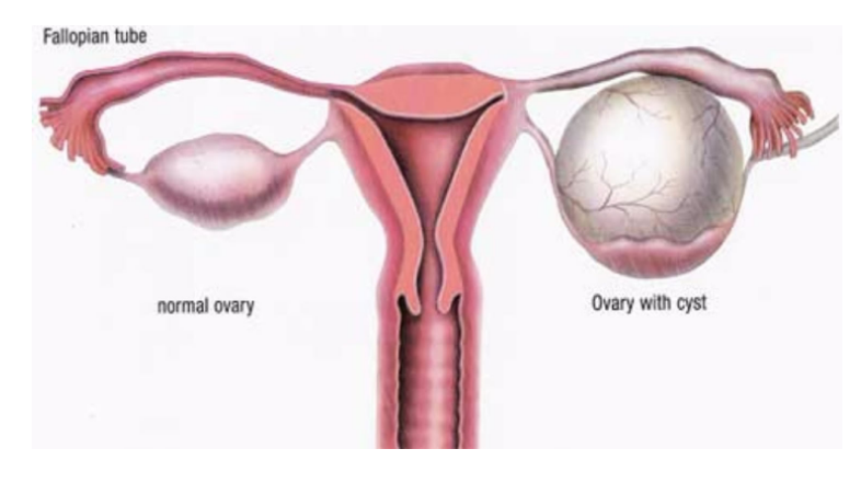 کیست تخمدان درمان هومیوپاتی homeopathy ovarian cyst دکتر جلال میرعبداله