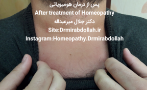 درمان پسوریازیس بوسیله طب هومیوپاتی - دکتر جلال میرعبداله -psoriasis homeopathy-drmirabdollah.ir 