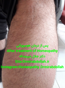 -drmirabdollah.ir - درمان پسوریازیس بوسیله طب هومیوپاتی - دکتر جلال میرعبداله -psoriasis homeopathy