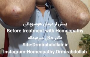 درمان پسوریازیس بوسیله طب هومیوپاتی - دکتر جلال میرعبداله -psoriasis homeopathy- drmirabdollah.ir