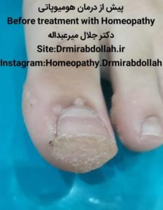 درمان زگیل انگشت بوسیله طب هومیوپاتی homeopathy wart دکتر جلال میرعبداله drmirabdollah.ir