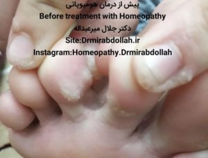 درمان زگیل انگشت بوسیله طب هومیوپاتی homeopathy wart دکتر جلال میرعبداله drmirabdollah.ir