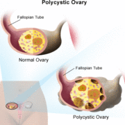poly cystic ovary , homeopathy تخمدان پلی کیستیک درمان هومیوپاتی Drmirabdollah.ir