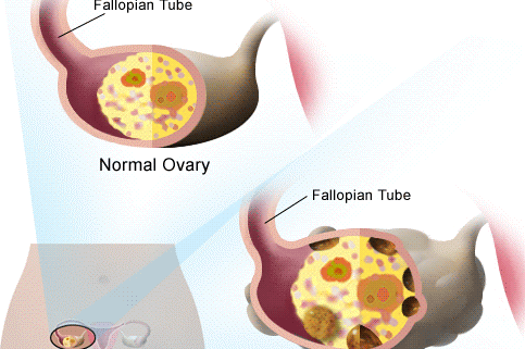 poly cystic ovary , homeopathy تخمدان پلی کیستیک درمان هومیوپاتی Drmirabdollah.ir
