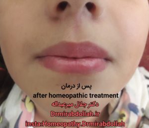 هومیوپاتی زگیل لب HOMEOPATHY LIP WART دکتر جلال میرعبداله