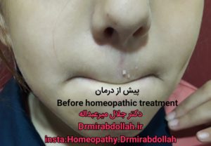 هومیوپاتی زگیل لب HOMEOPATHY LIP WART دکتر جلال میرعبداله