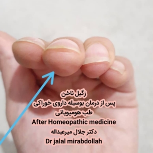wart homeopathy زگیل انگشت ناخن درمان با طب هومیوپاتی