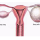 کیست تخمدان درمان هومیوپاتی homeopathy ovarian cyst دکتر جلال میرعبداله