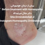 -DRMIRABDOLLAH.IR-پسوریازیس دکتر جلال میرعبداله -هومیوپاتی-HOMEOPATHY